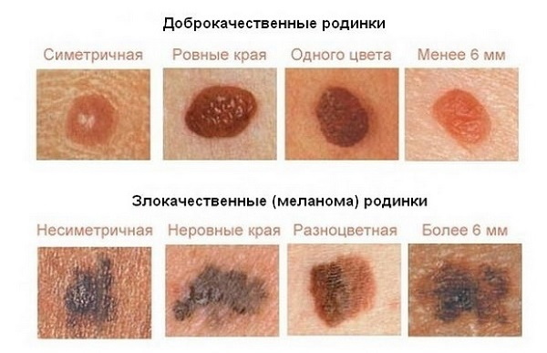 Новообразования на коже – Медицинский центр ЭЛИТМЕД Мытищи